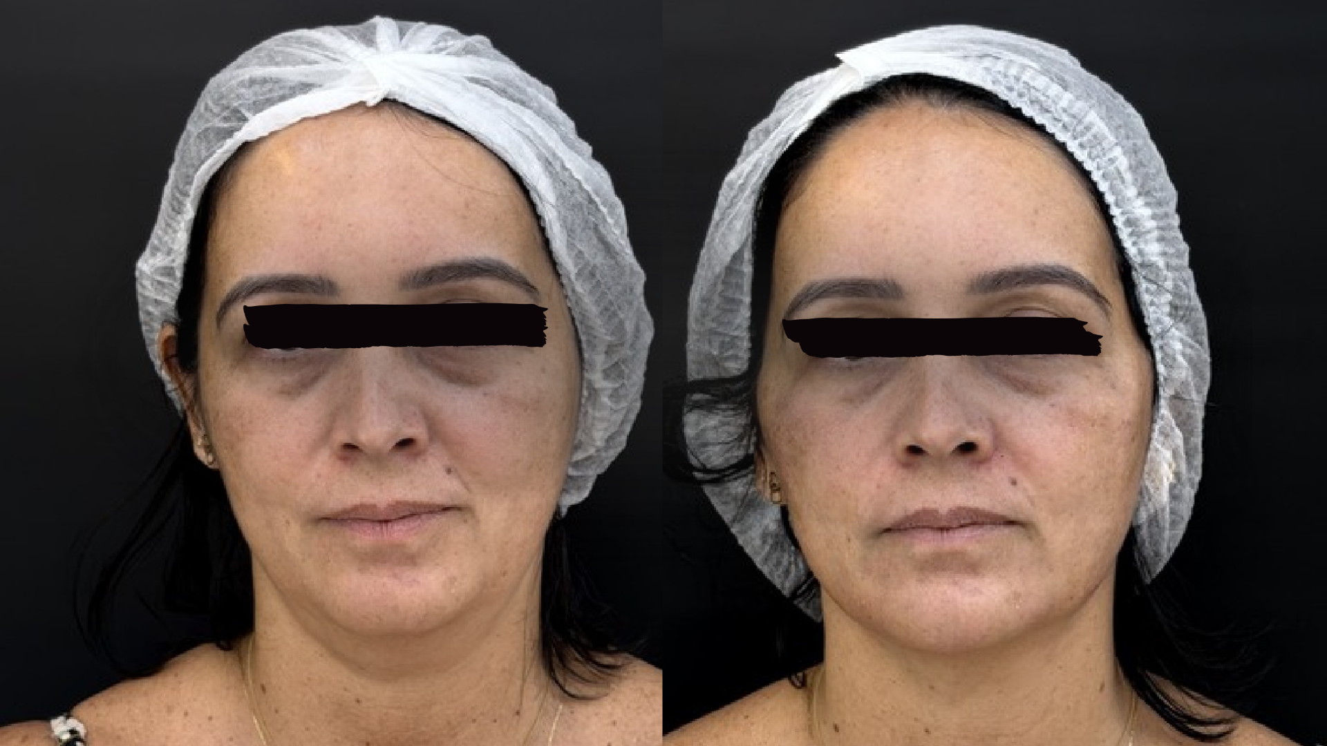 Tratamentos Faciais. 5