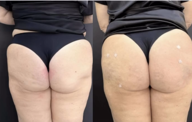 Glútea IMEX. 1
